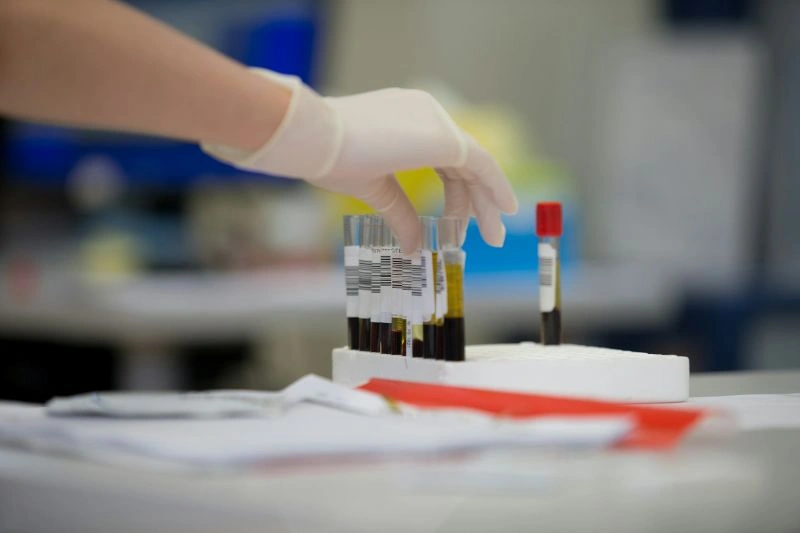 Laboratory blood sample testing used to help distinguish IBD vs IBS conditions