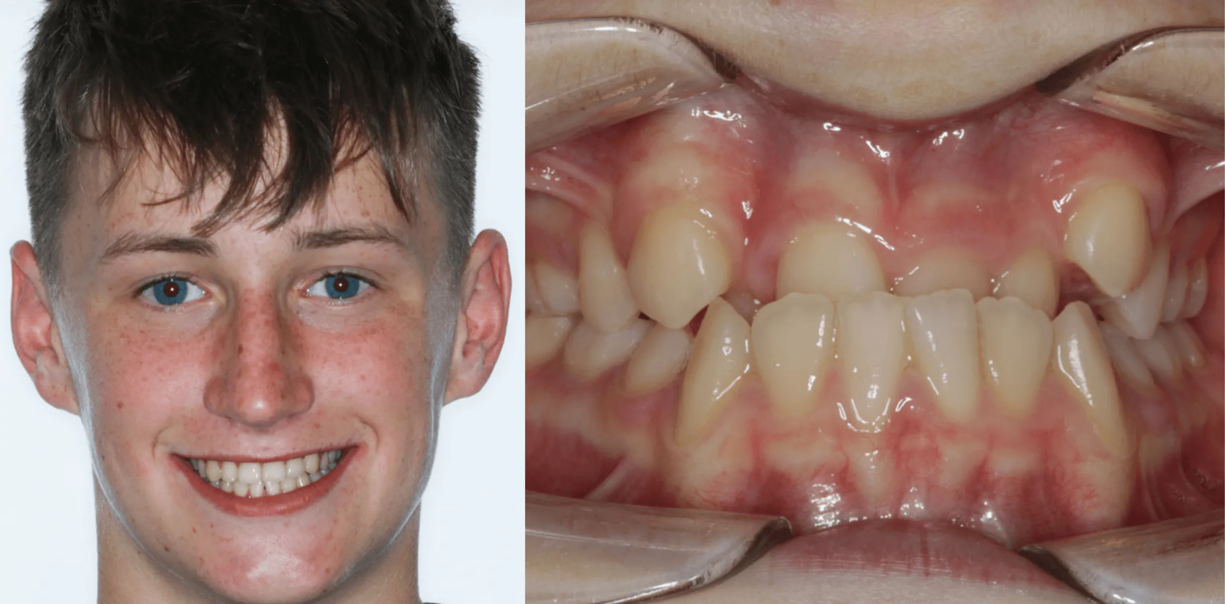 how much are braces in the uk