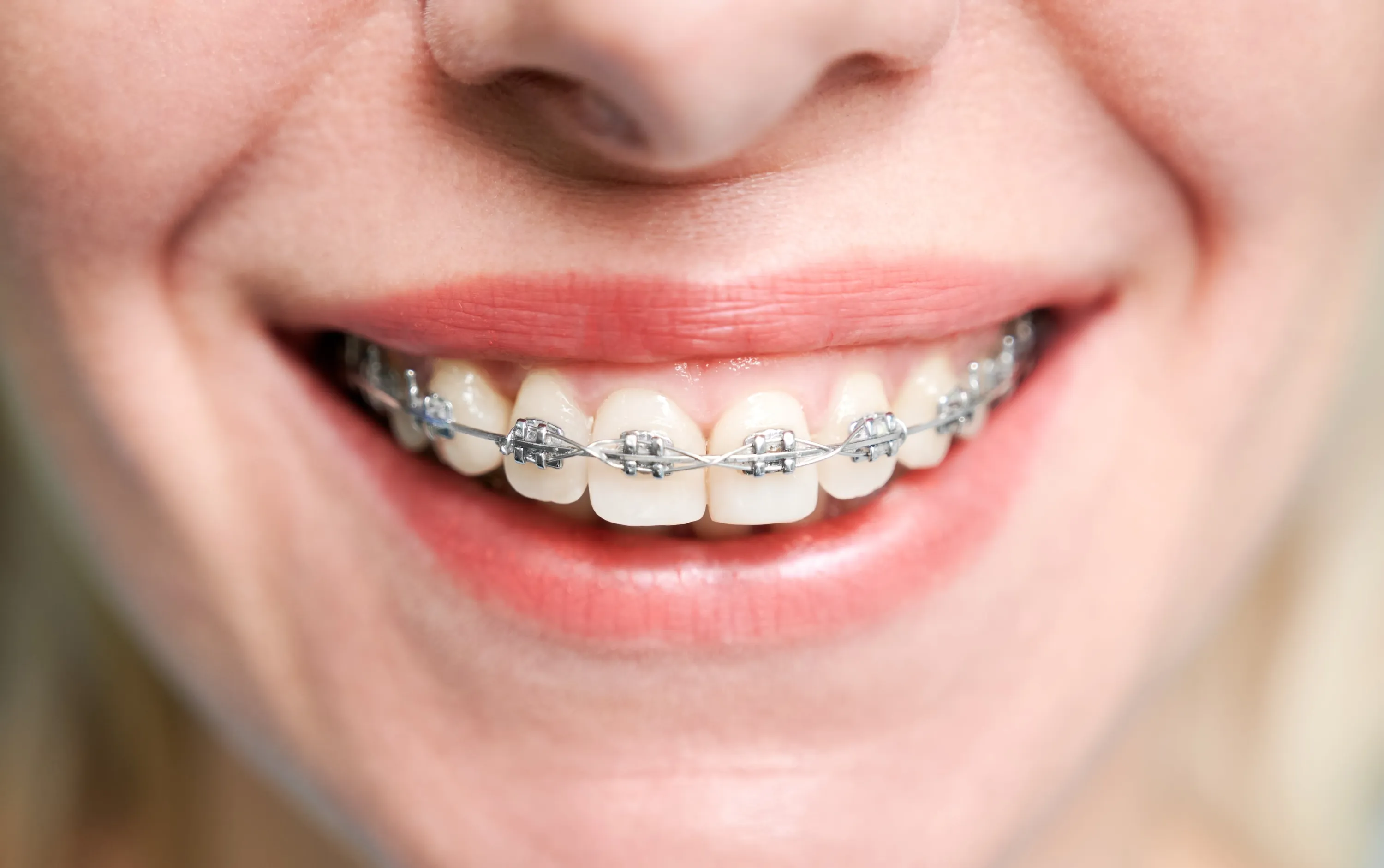 how much does it cost to get braces uk