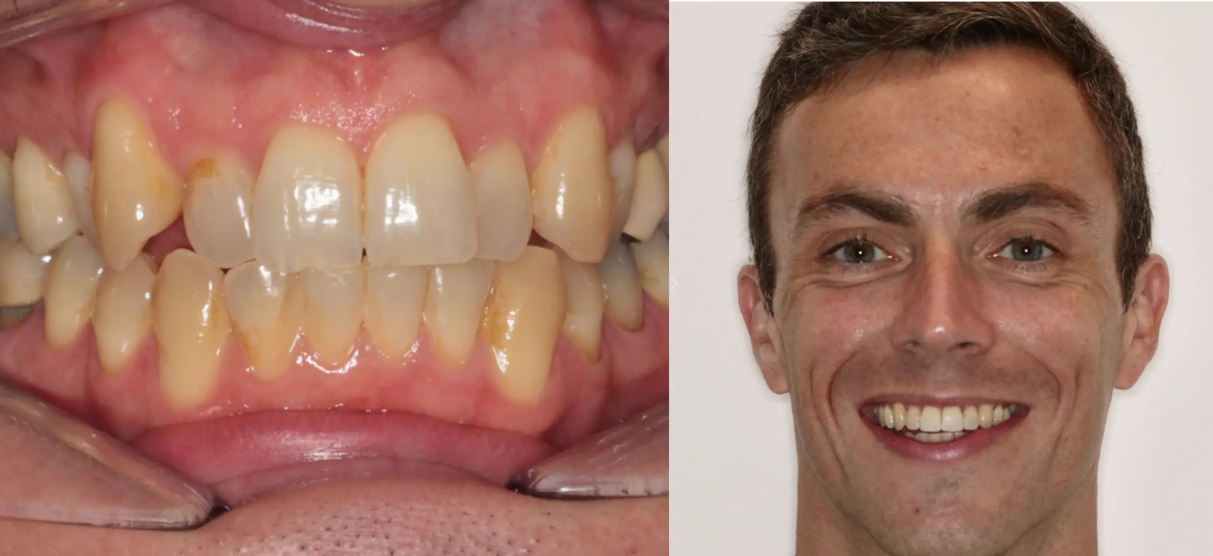 invisalign cost uk london