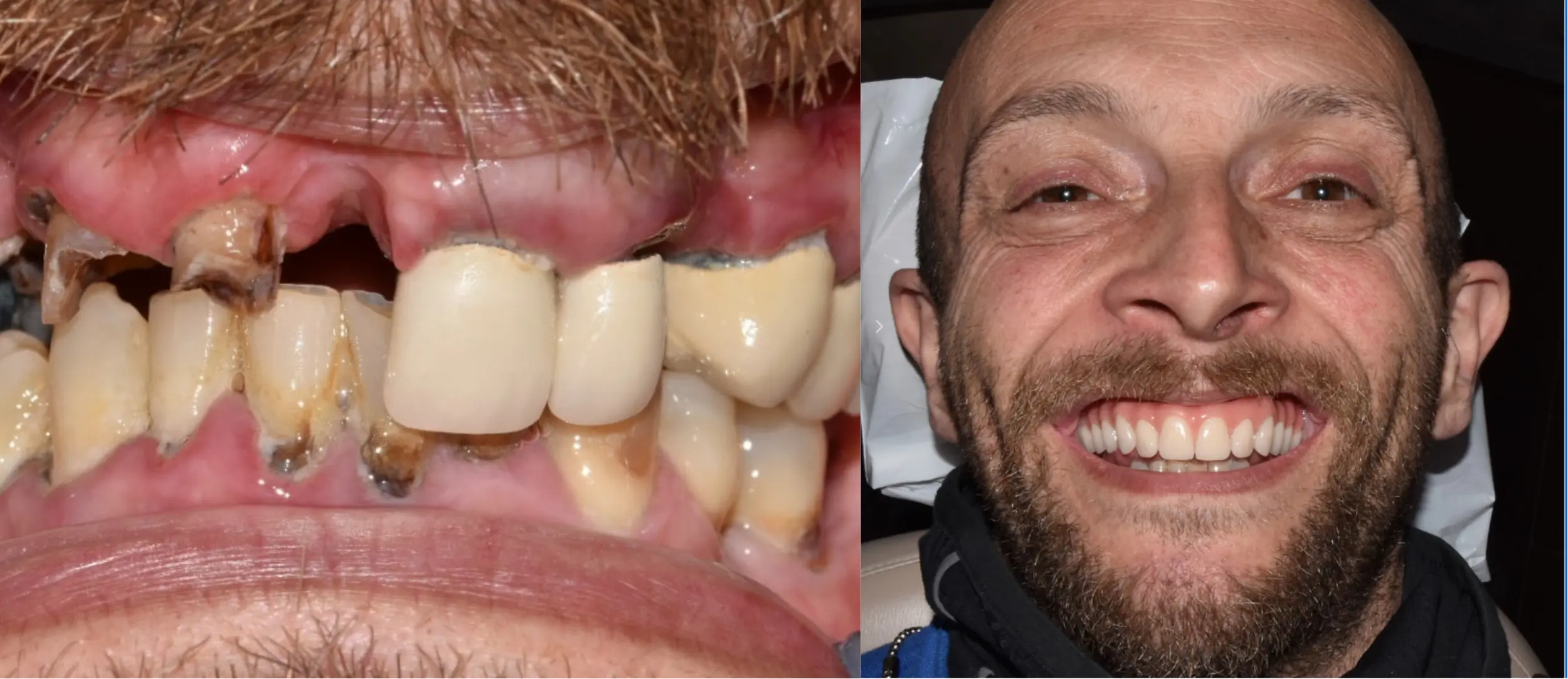 Costs of Full Arch Implants in the UK