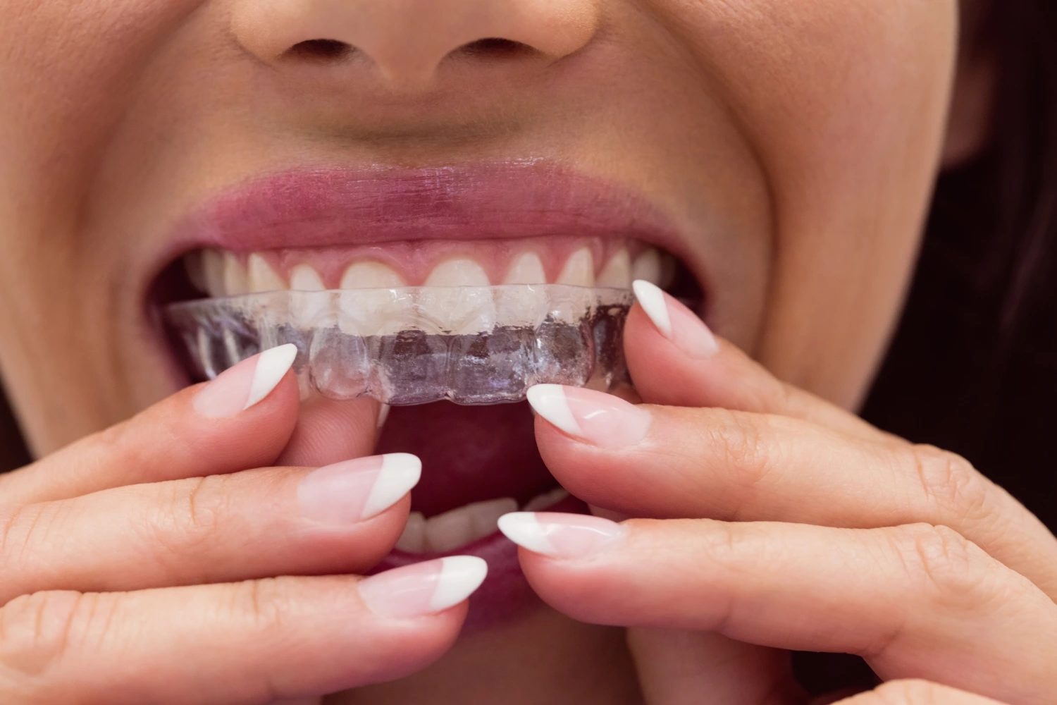 type of breaces - Clear Aligners (Invisalign and Angel Aligners)