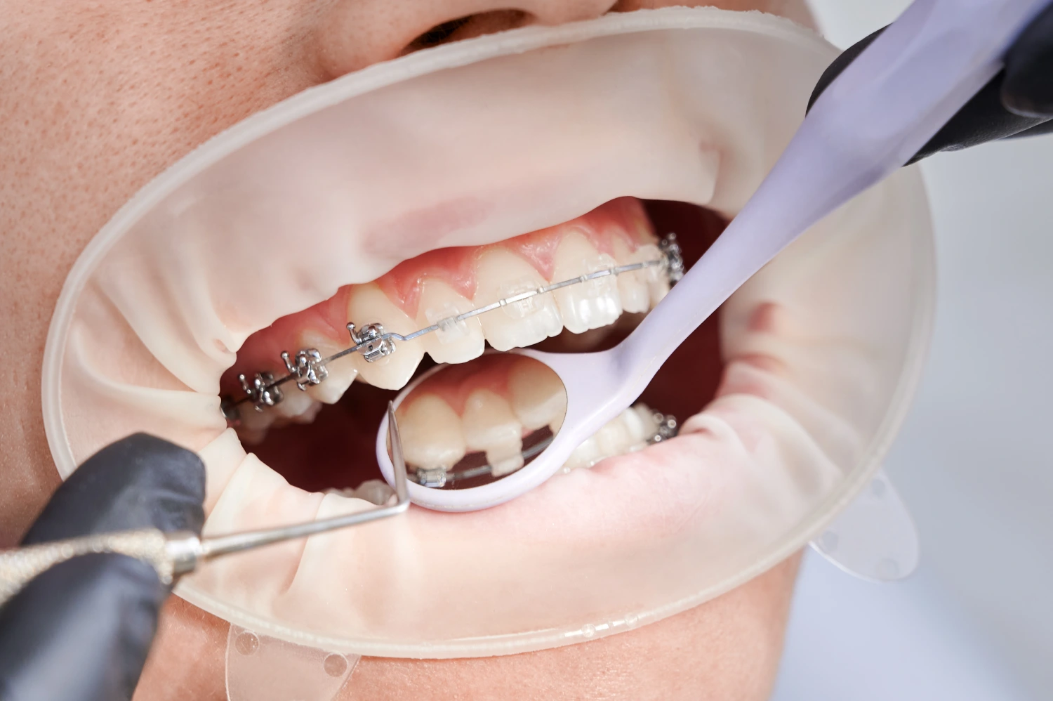 Choose the Right Type of Braces for Straightening Your Teeth