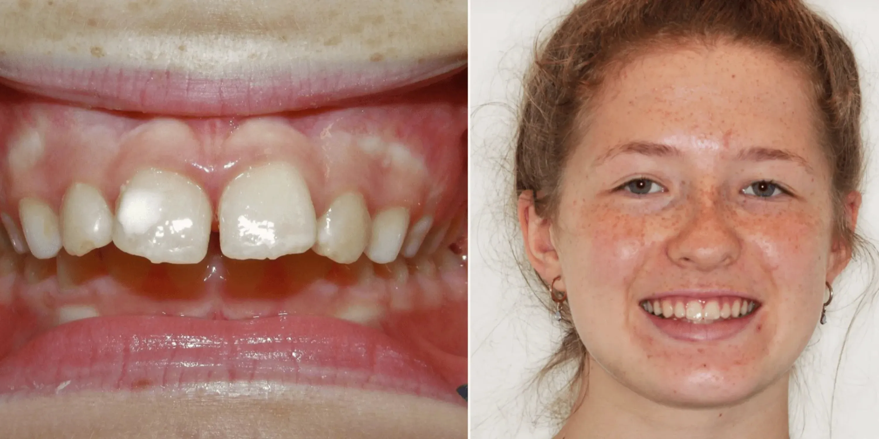 Braces Before & After case of overbite 