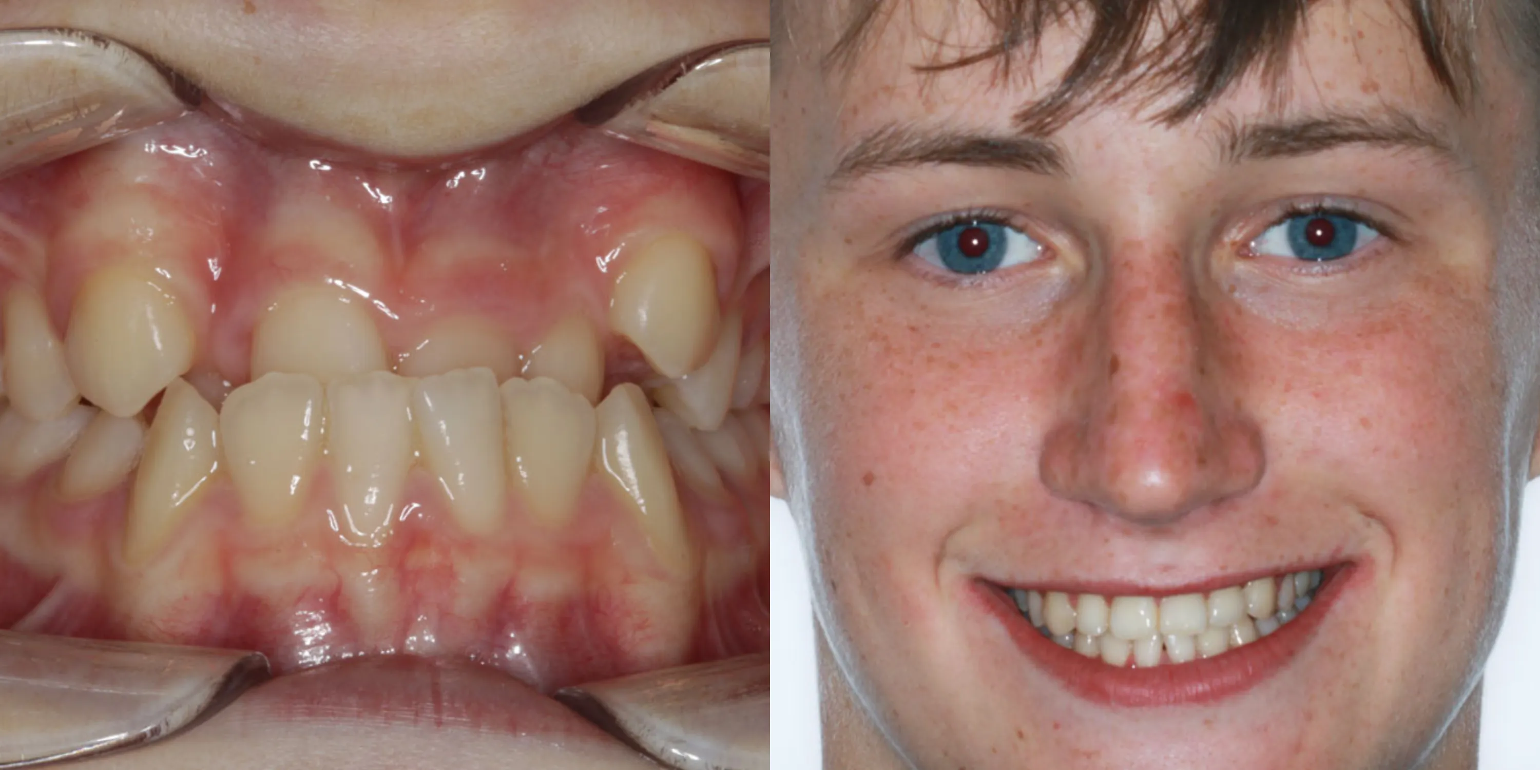Braces Before & After case of underbite 