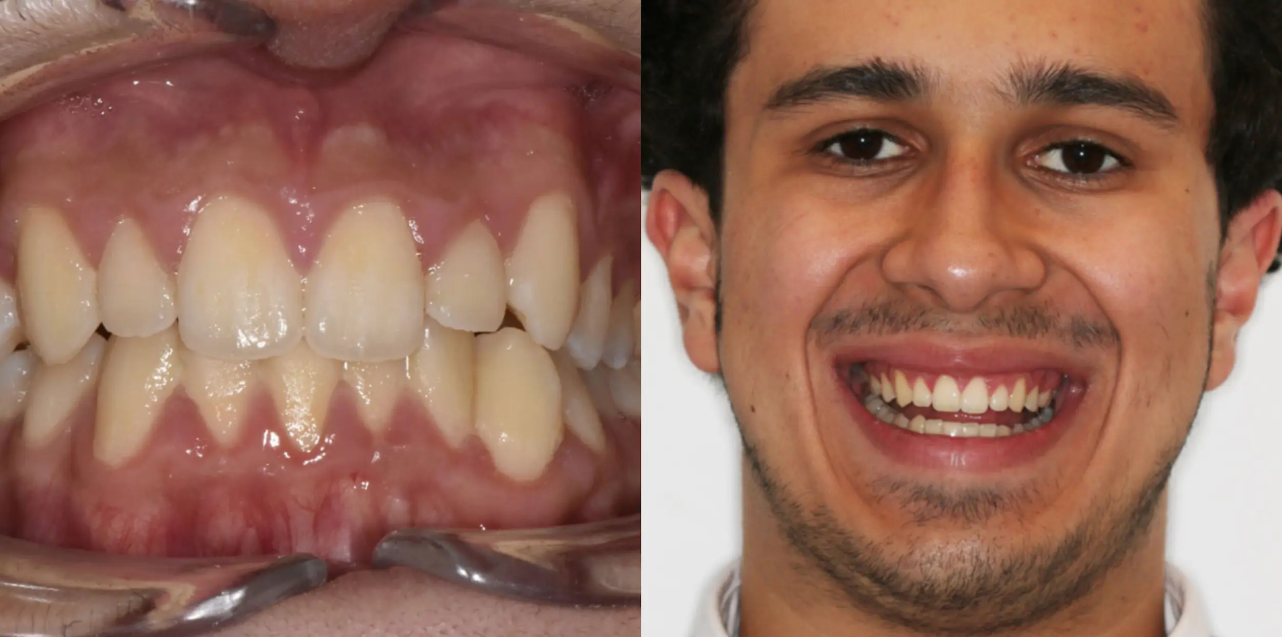 Before and After Pictures of How We Fixed Crowded Teeth with Invisalign