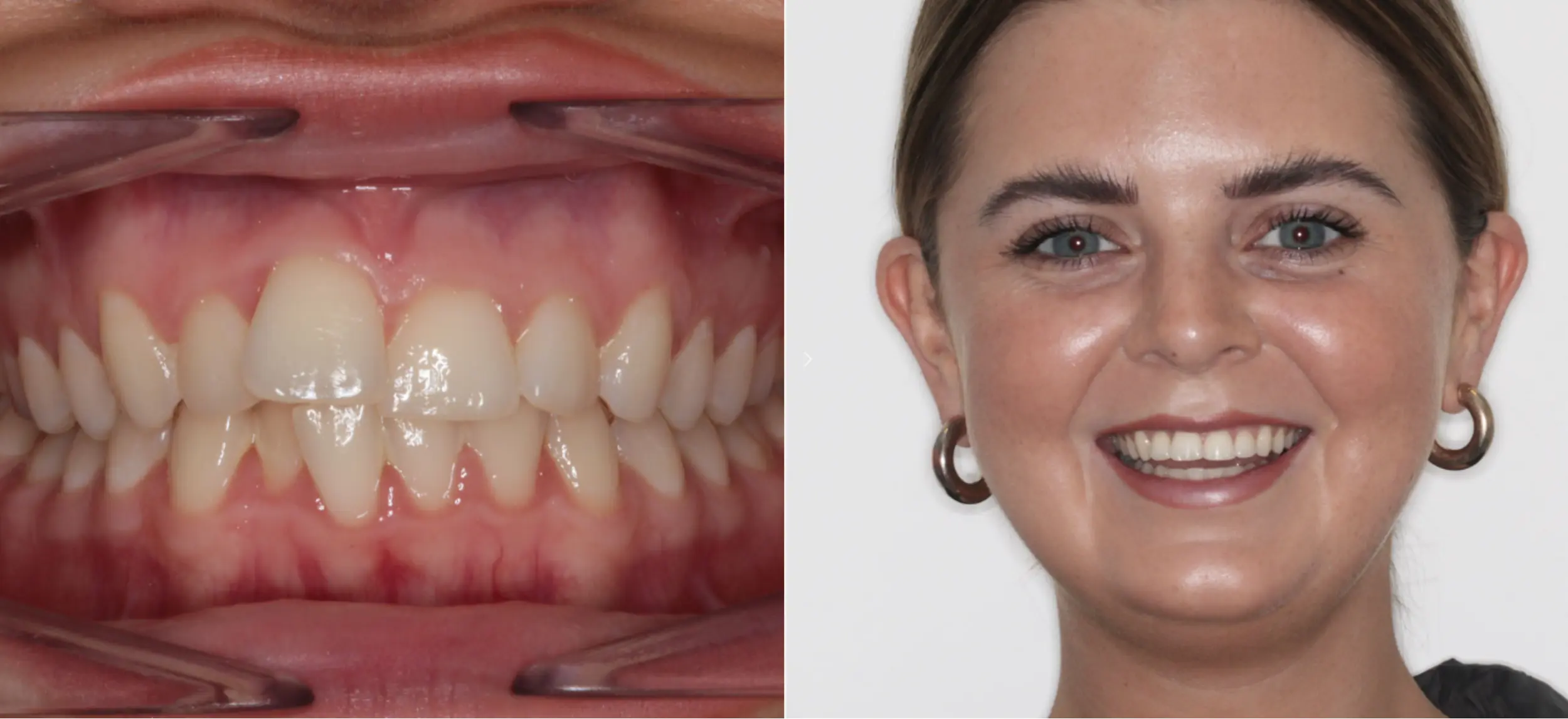 Invisalign before and after