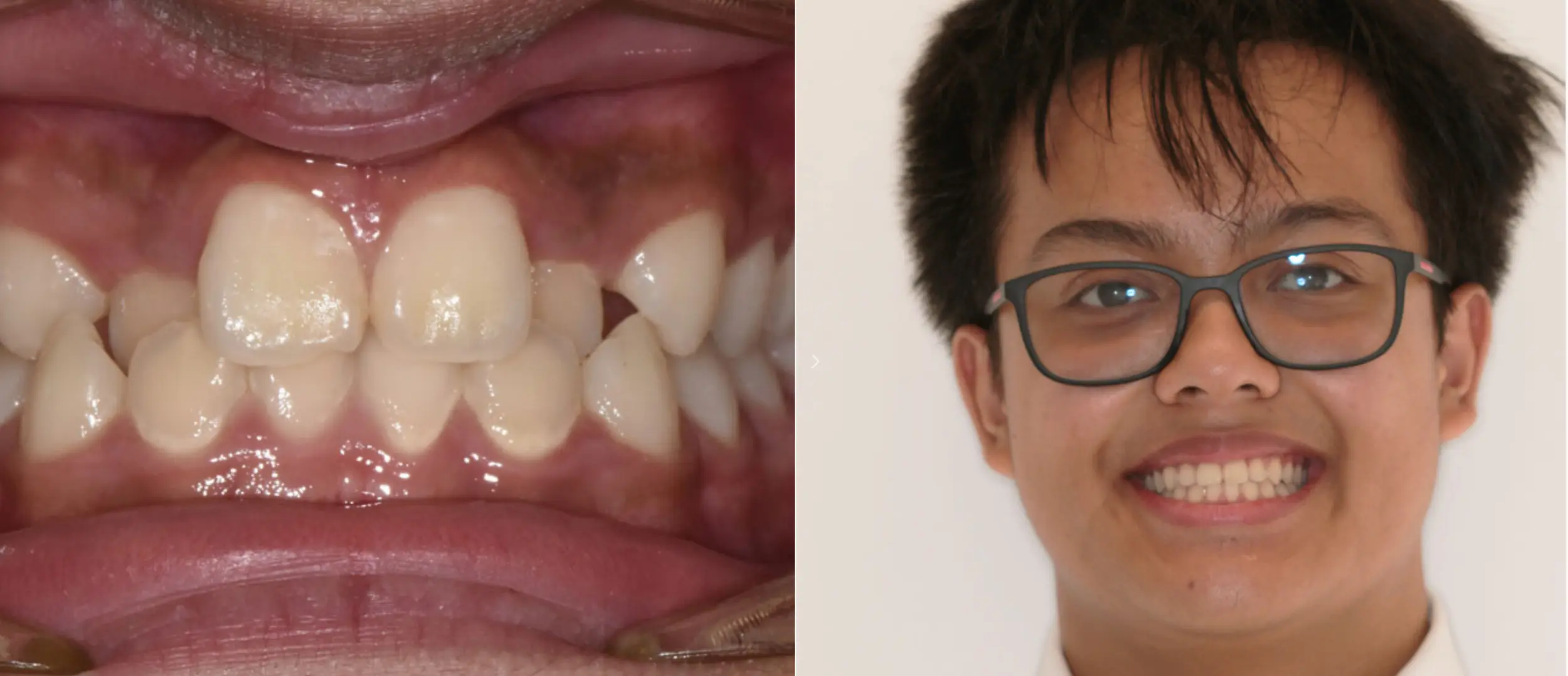 Before and After Pictures of How We Fixed a Cross Bite with Invisalign