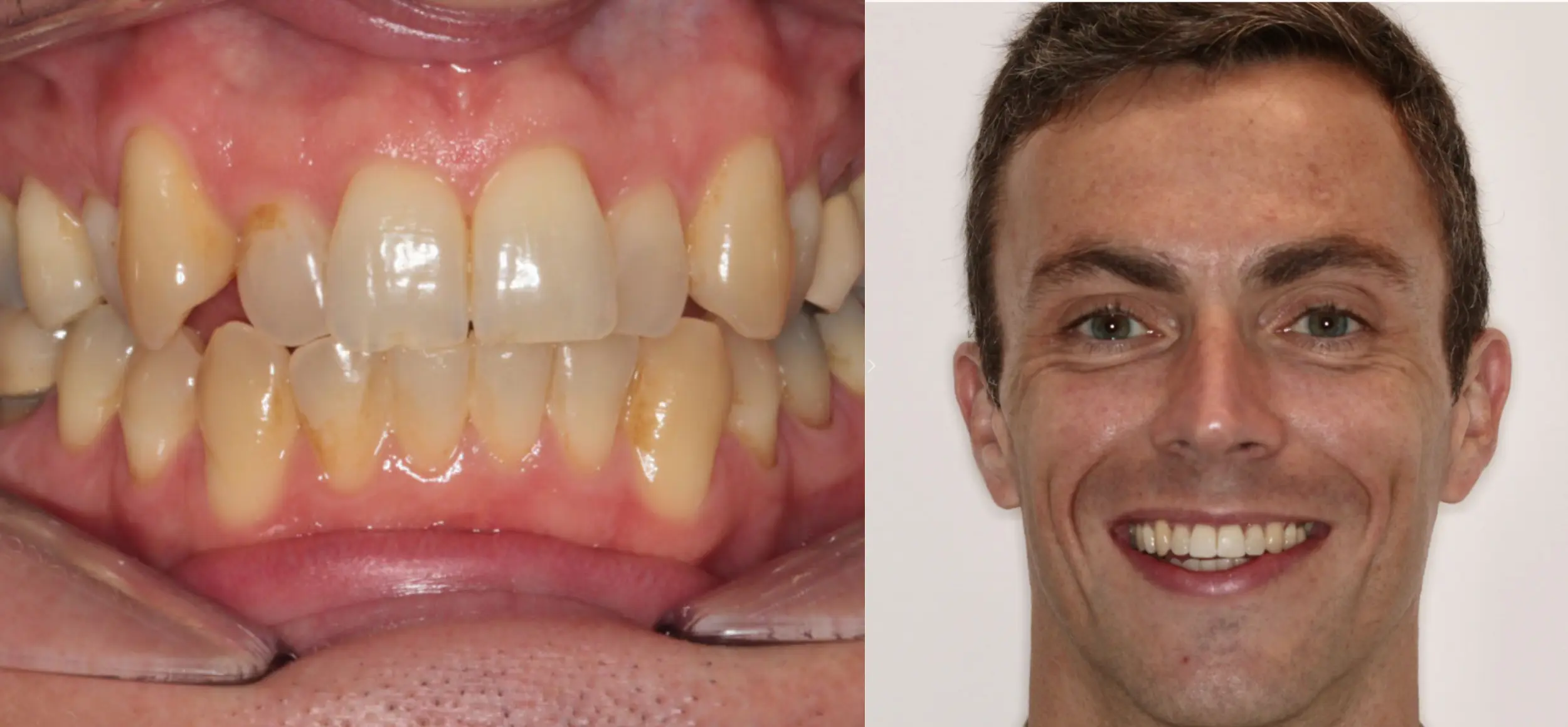 Before and After Pictures of How We Corrected Severe Crowding and Crossbite with Invisalign