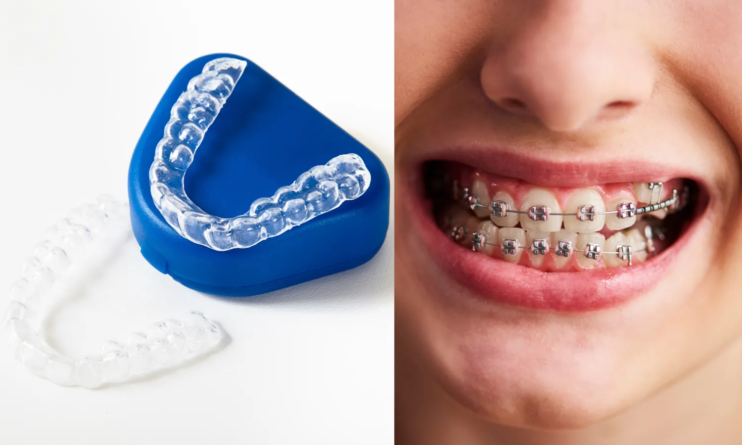 Invisalign vs Braces: Which Is Right for You?