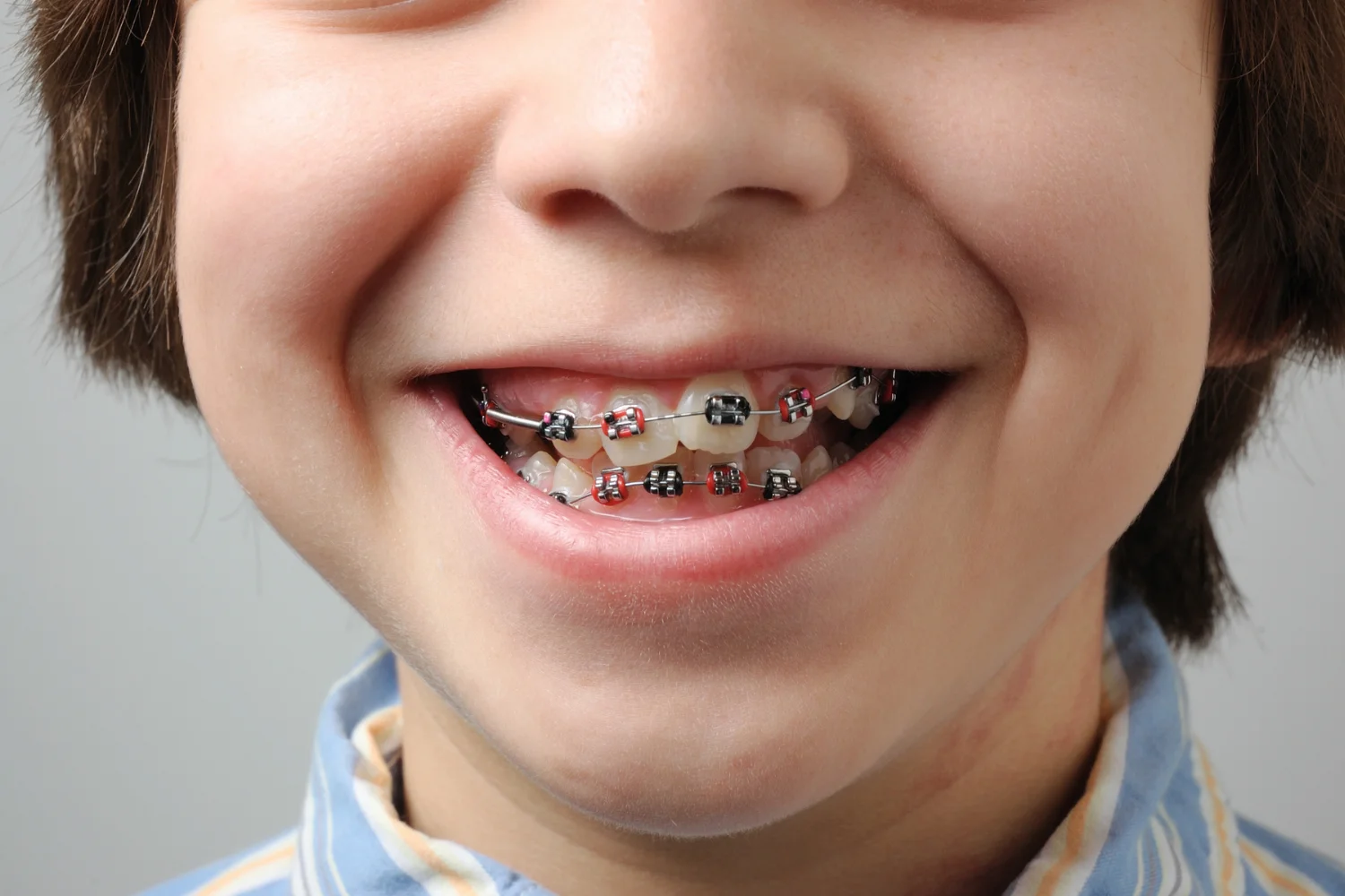 How to Fix Crooked Teeth with Orthodontic and Surgical Methods