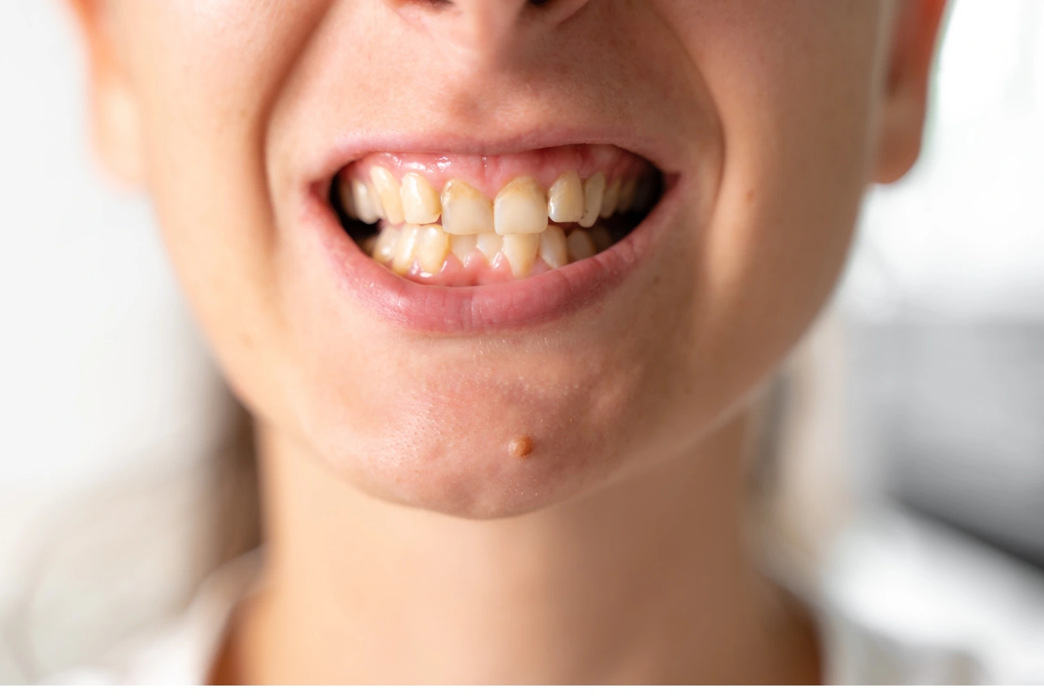 What Causes Crooked Teeth?