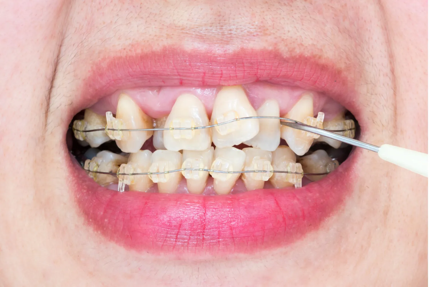Is It Possible to Treat Crooked Teeth in Adults?