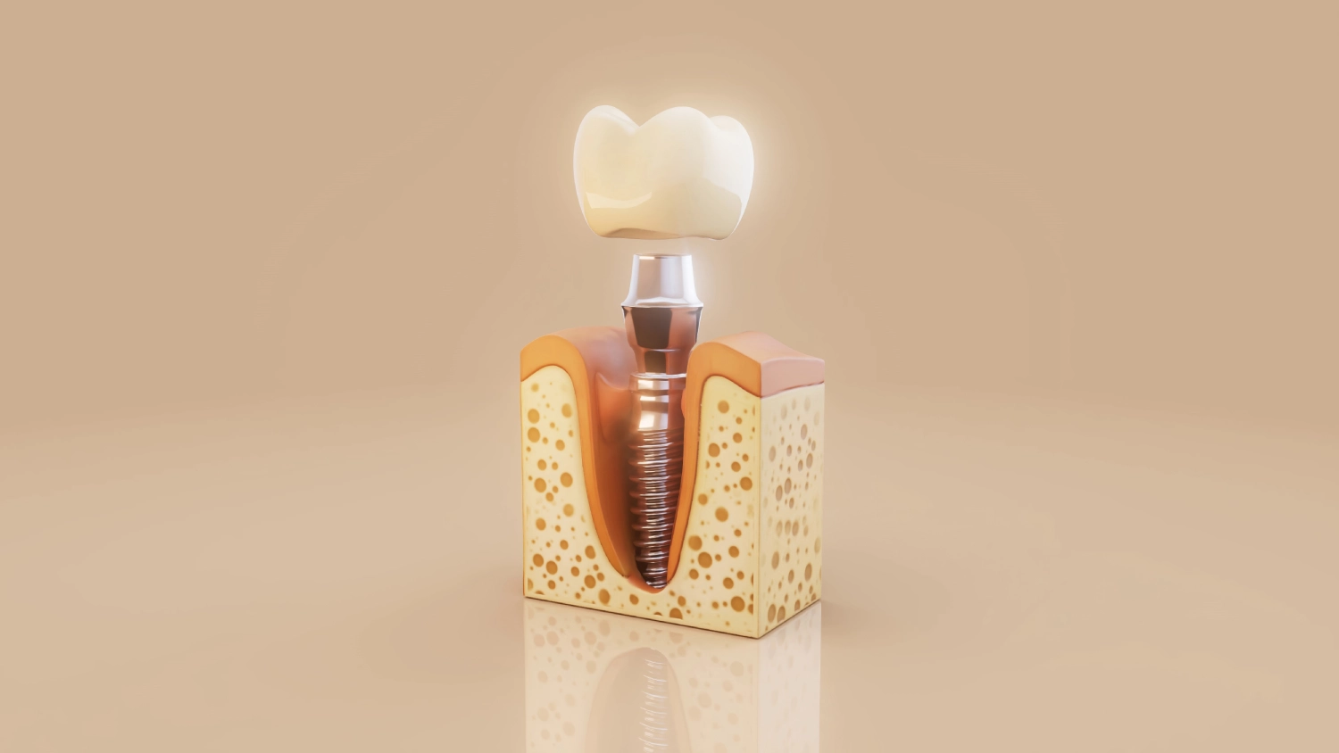 Single Tooth Implants - Types of Dental Implants