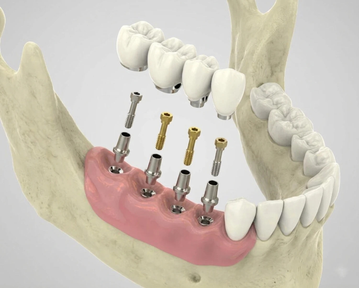 Endosteal dental Implants