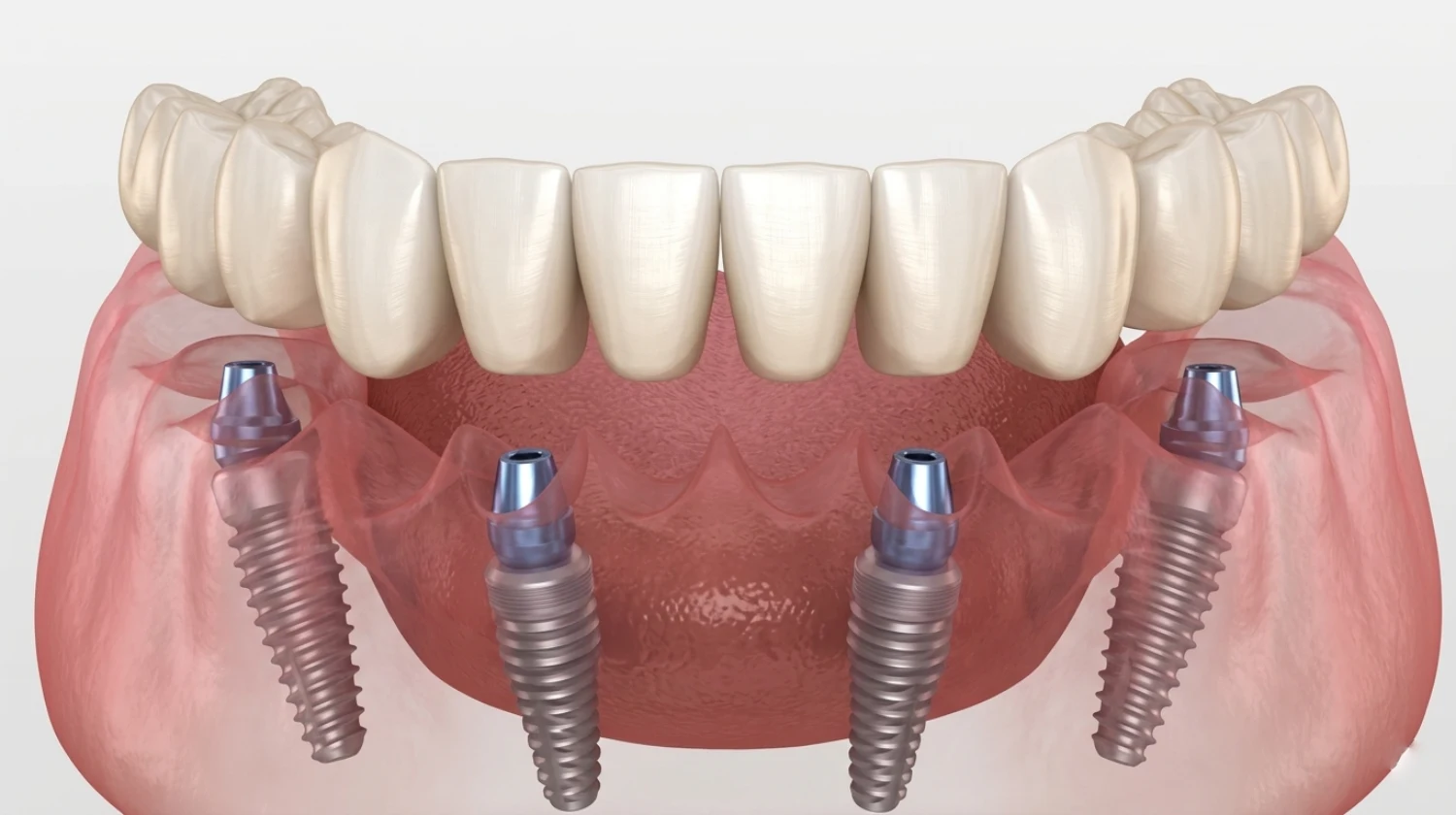 Types of Dental Implants: All-on-4 Implants