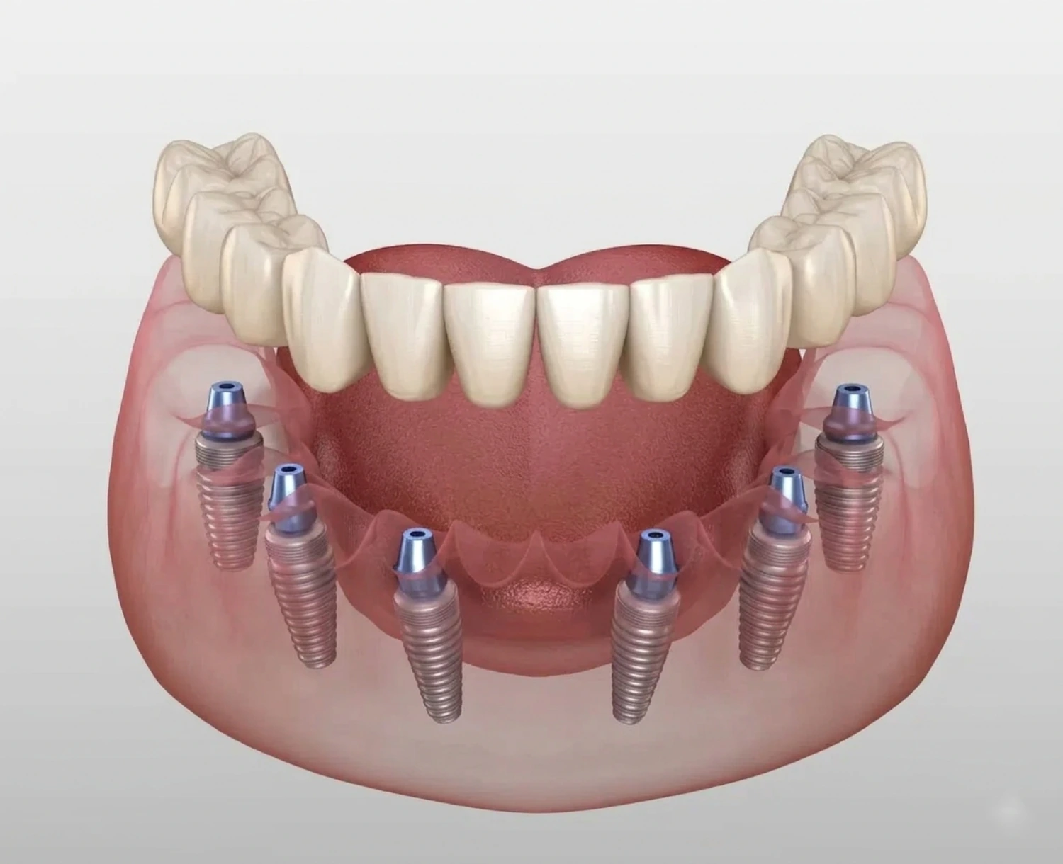 Types of Dental Implants: All-on-6 Implants