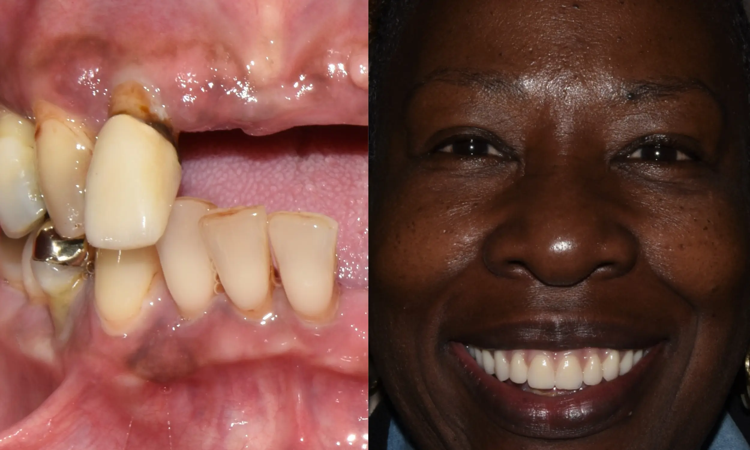 Before and After Pictures of How We Fixed Failing Upper Teeth with Dental Implants