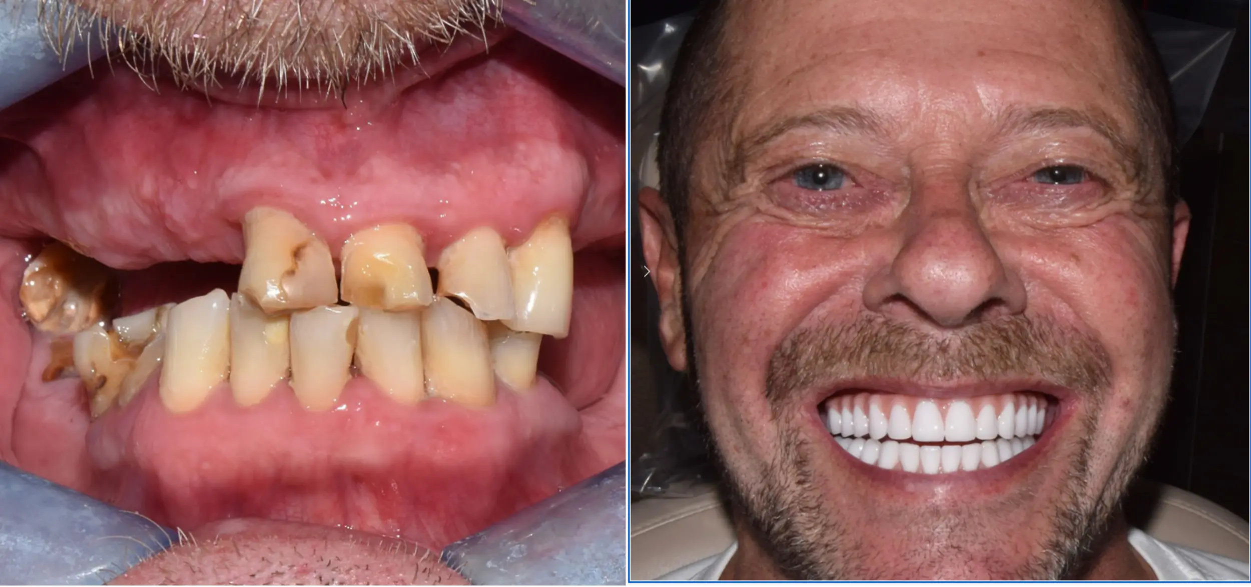 Before and After Pictures of How We Fixed Badly Damaged Teeth with Dental Implants
