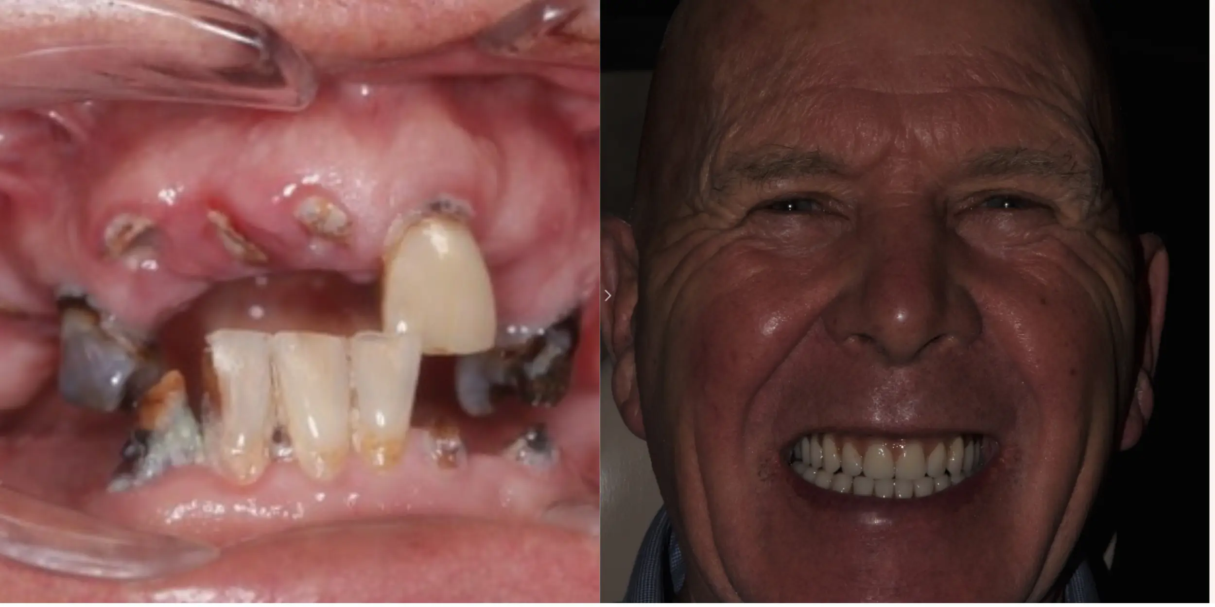 Before and After Pictures of How We Replaced Missing Teeth with Dental Implants