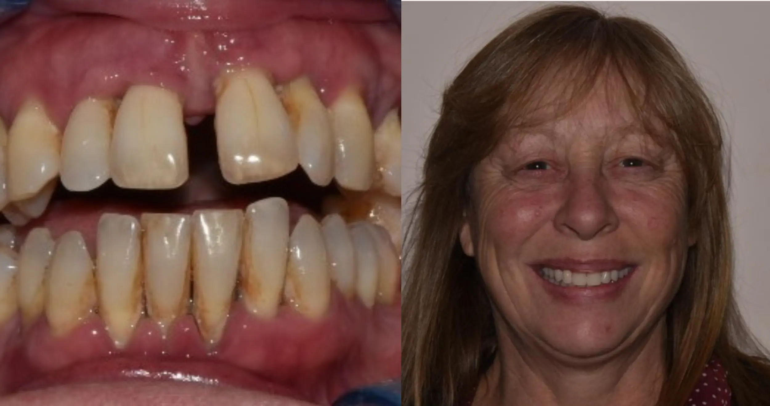 Dental Implants Before and After: Real Patient Transformation