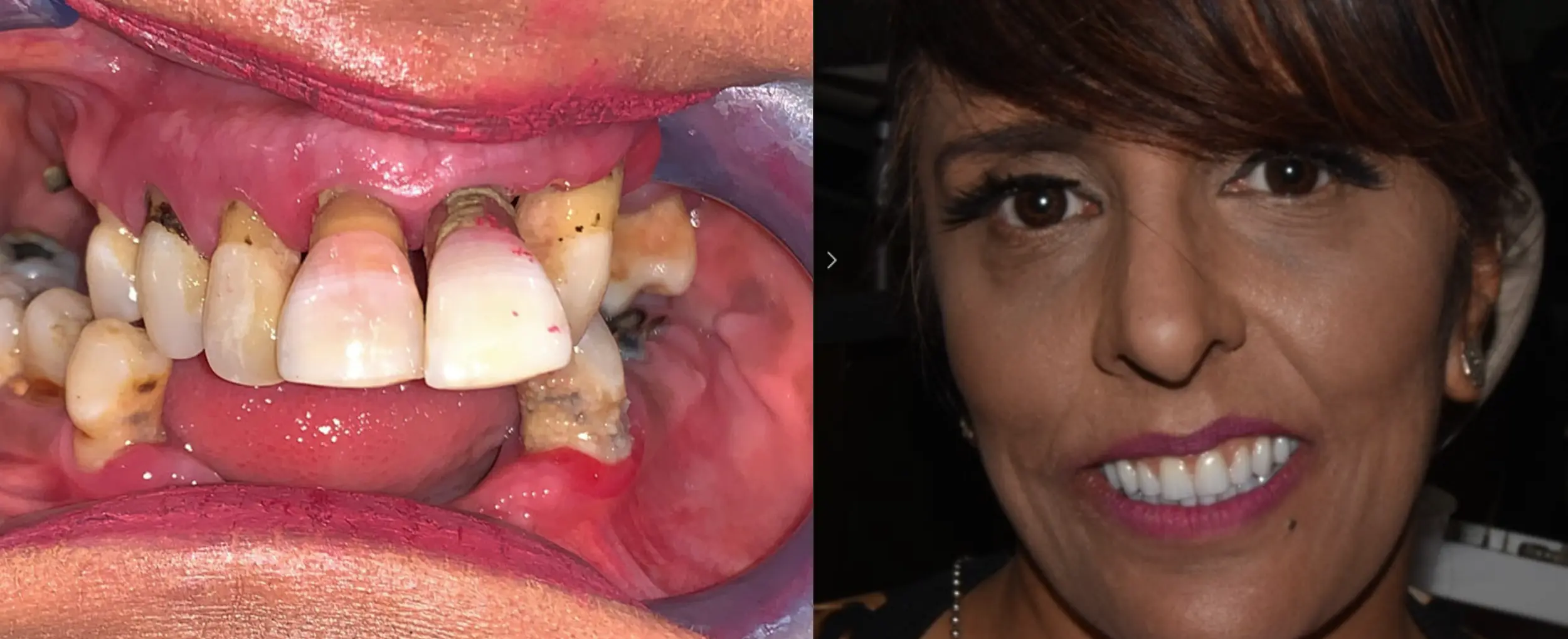 Before and After Pictures of How We Corrected Severely Drifted Teeth with Dental Implants
