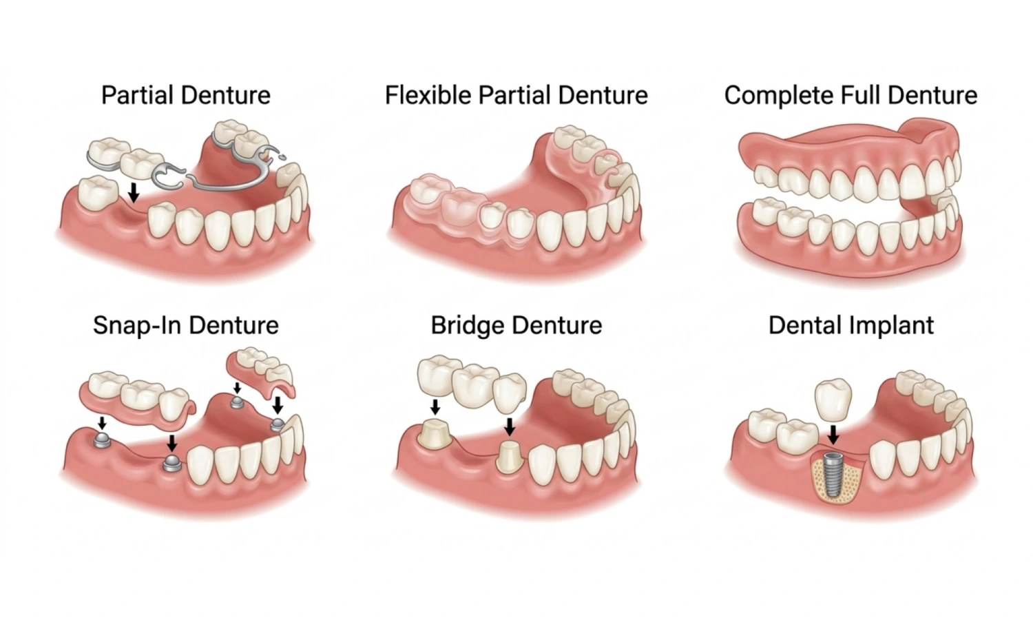 What Are Dentures?