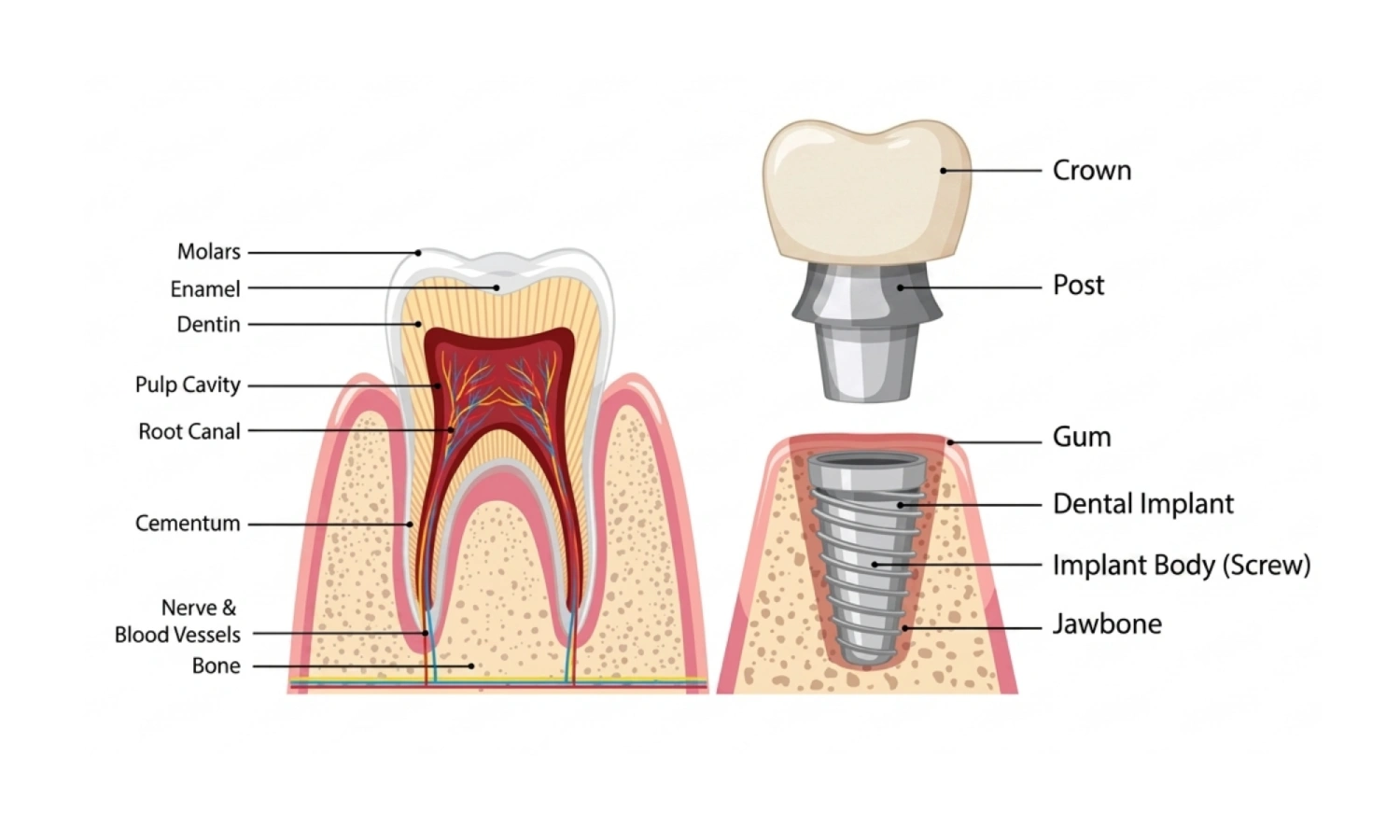 Dental Implants