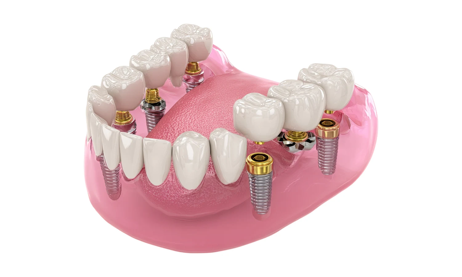 Types of Screwless Dental Implants
