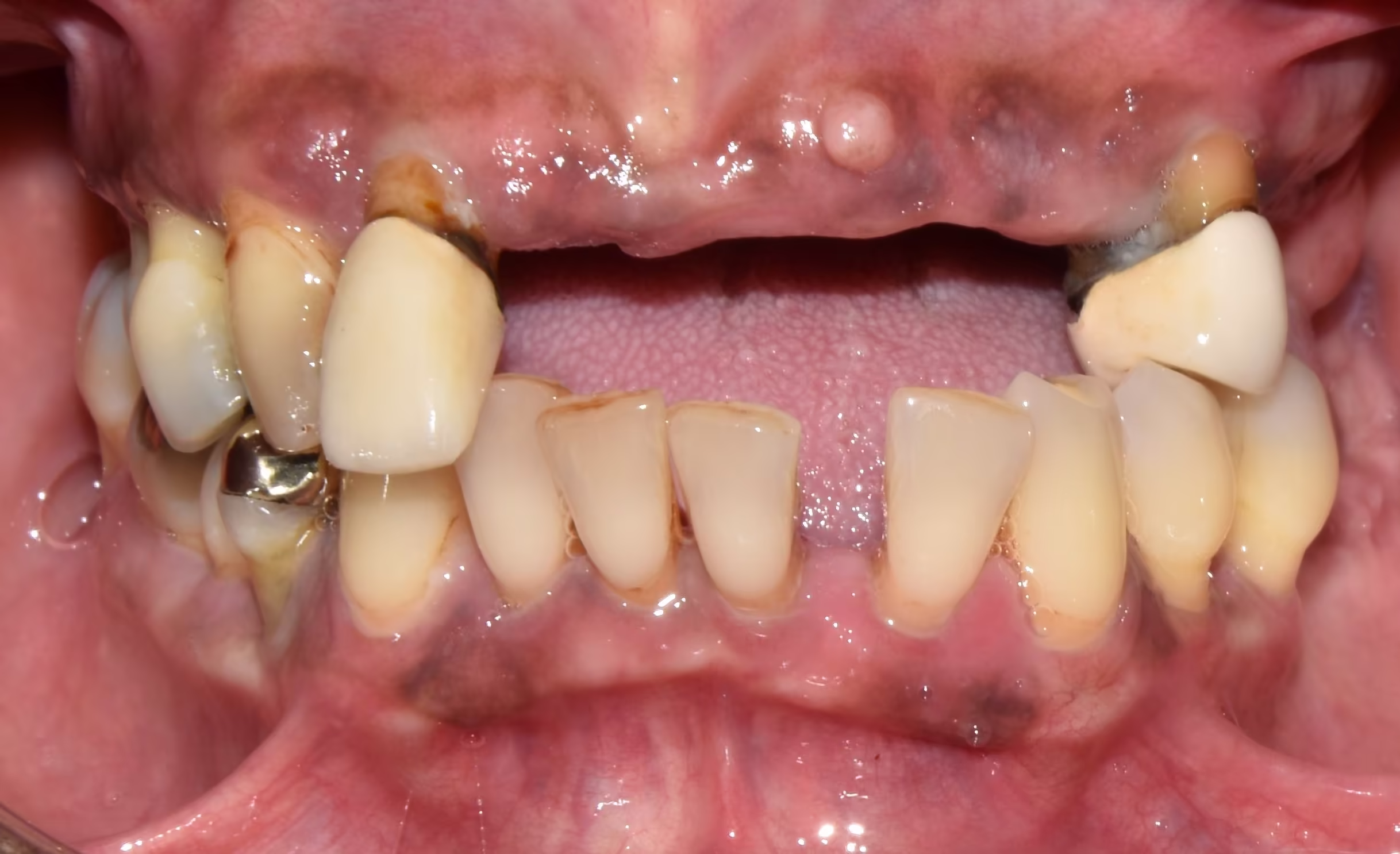 Zental patient's teeth before teeth in a day treatment