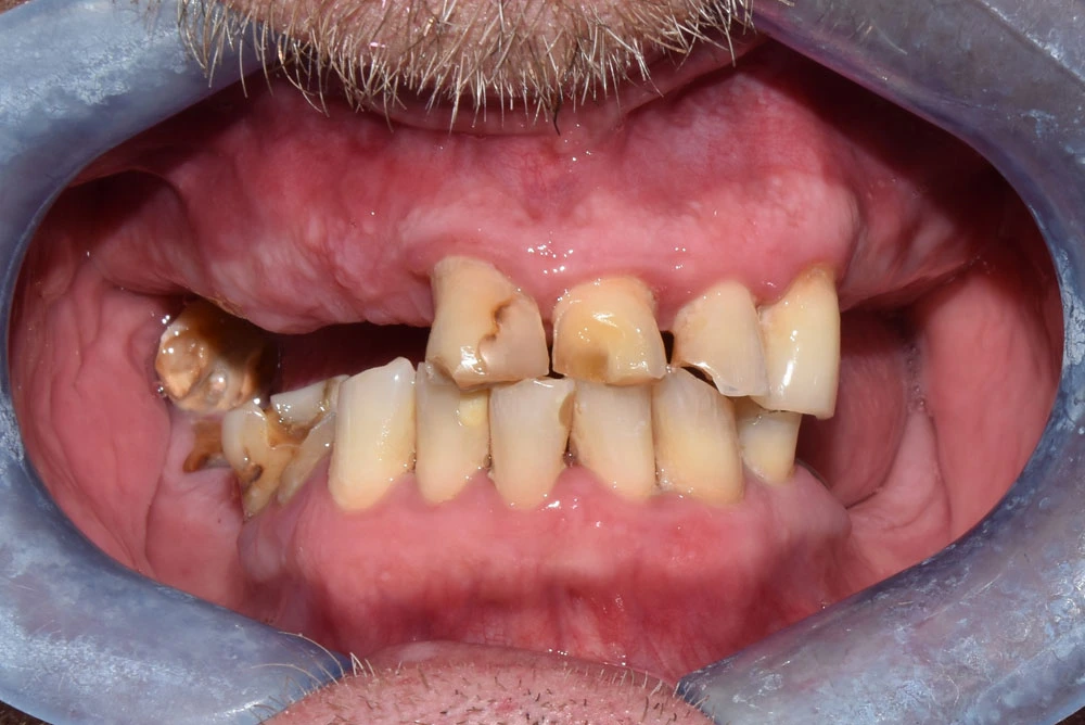 Zental patient's teeth before teeth in a day treatment