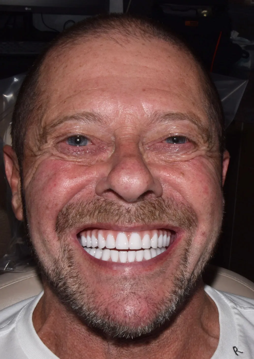 Zental patient's teeth after teeth in a day treatment