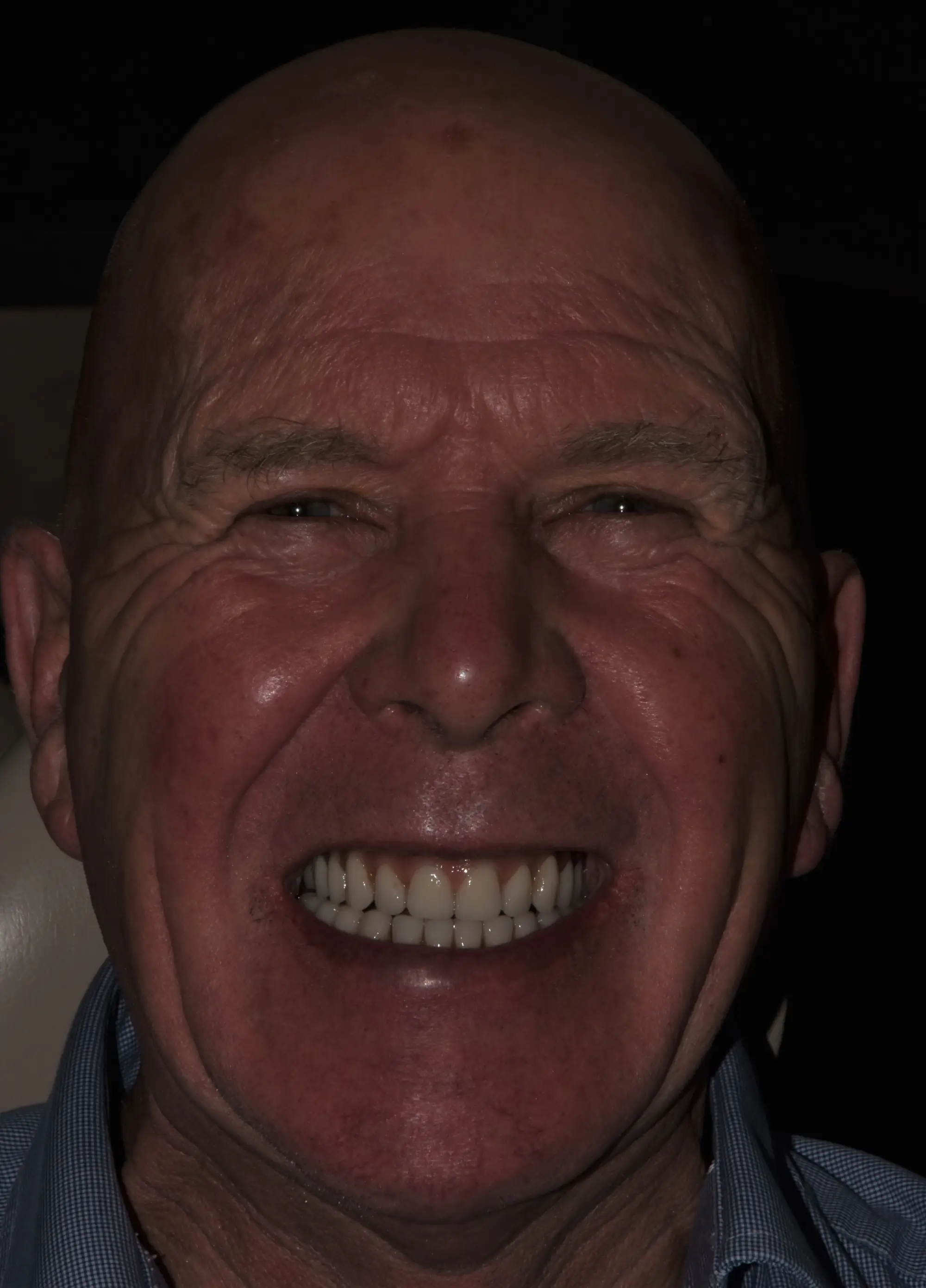 Zental patient's teeth after teeth in a day treatment