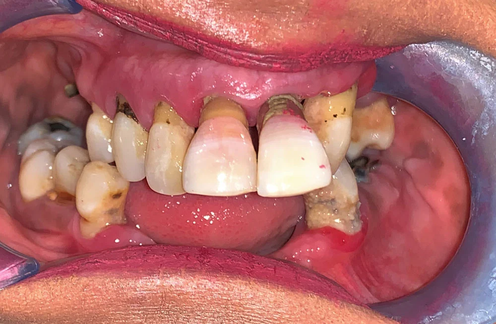 Zental patient's teeth before teeth in a day treatment