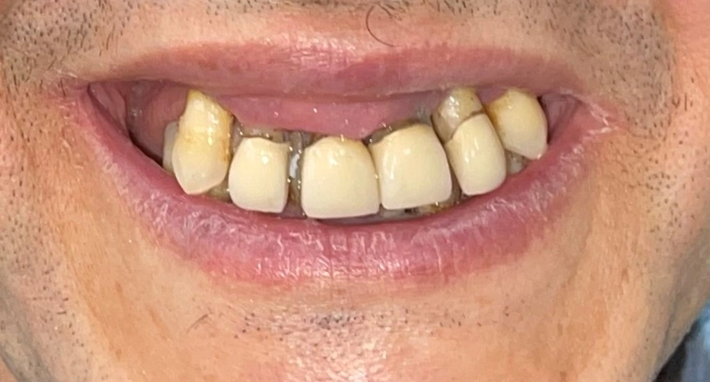 Zental patient's teeth before teeth in a day treatment