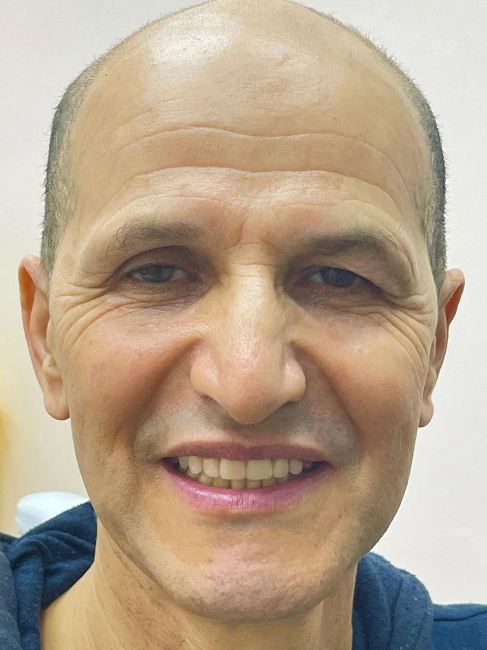 Zental patient's teeth after teeth in a day treatment