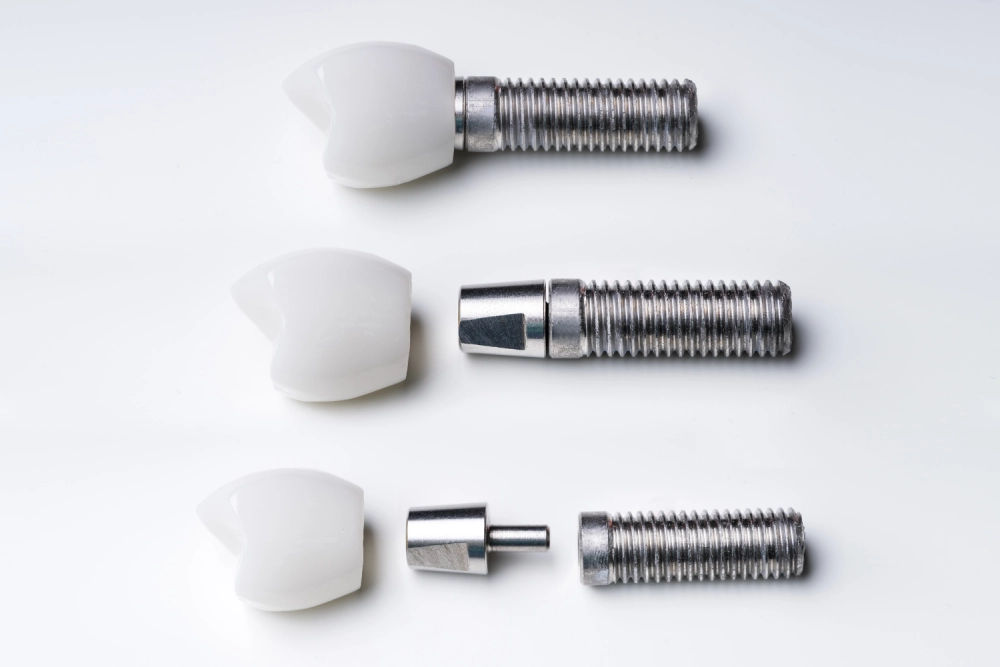 Dental Bridge vs Implant: What's the Best Option for You?