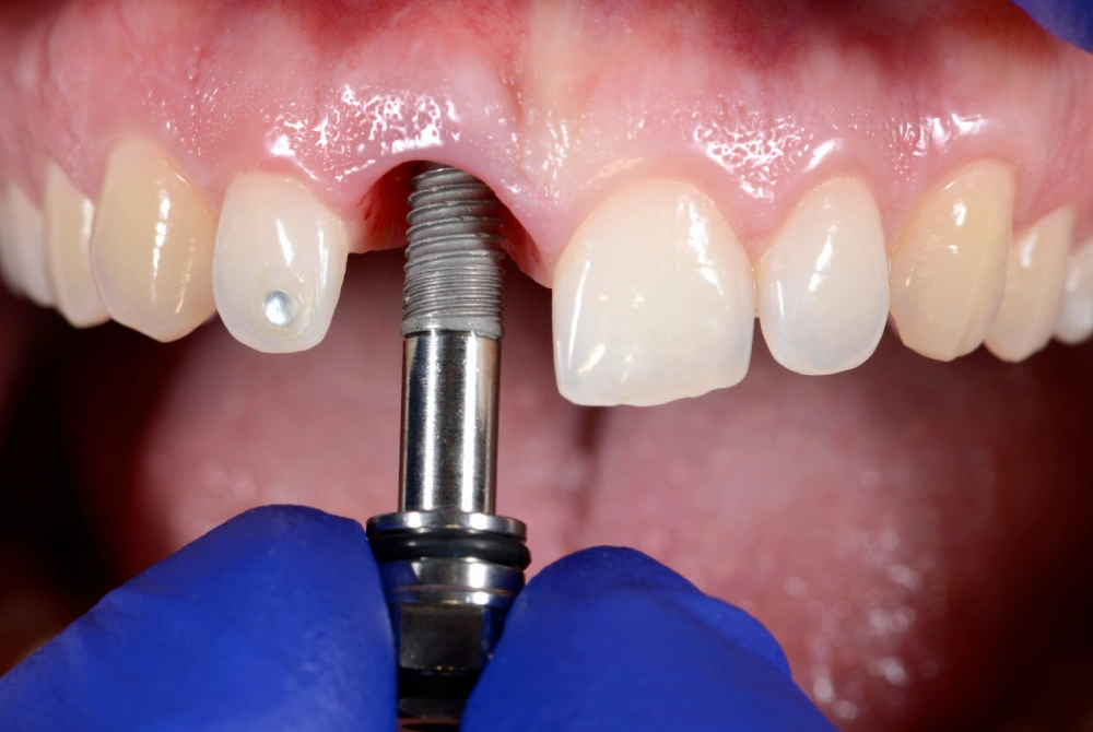 Dental Bridge vs Implant: Which Is Better for Oral Health?