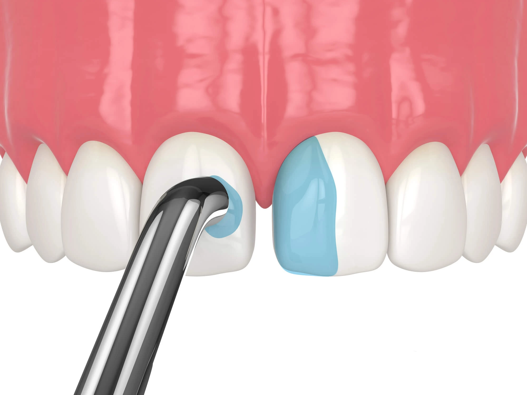 Best Dentist in Morton, IL Eliminating a Gap Between Teeth with Bonding