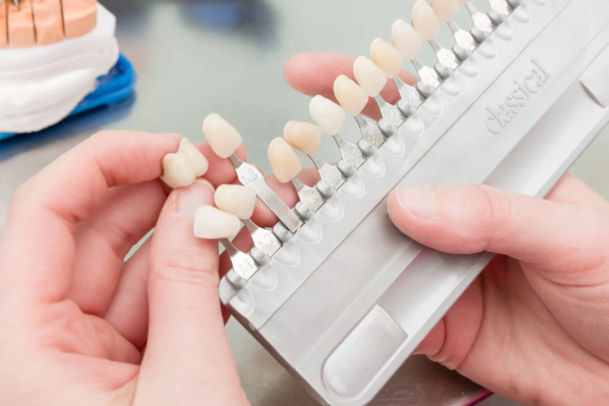 Can You Get Veneers on One Single Tooth?
