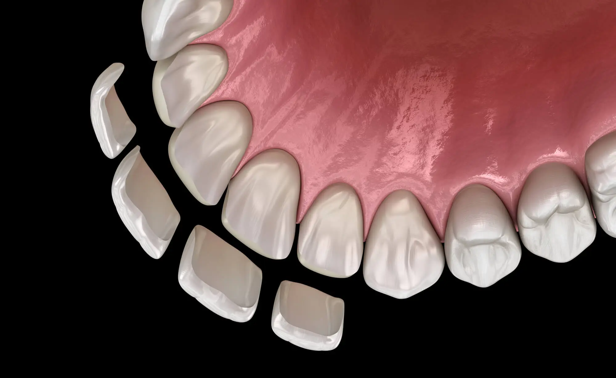 Illustration of Veneers by a Dentist in Pekin IL