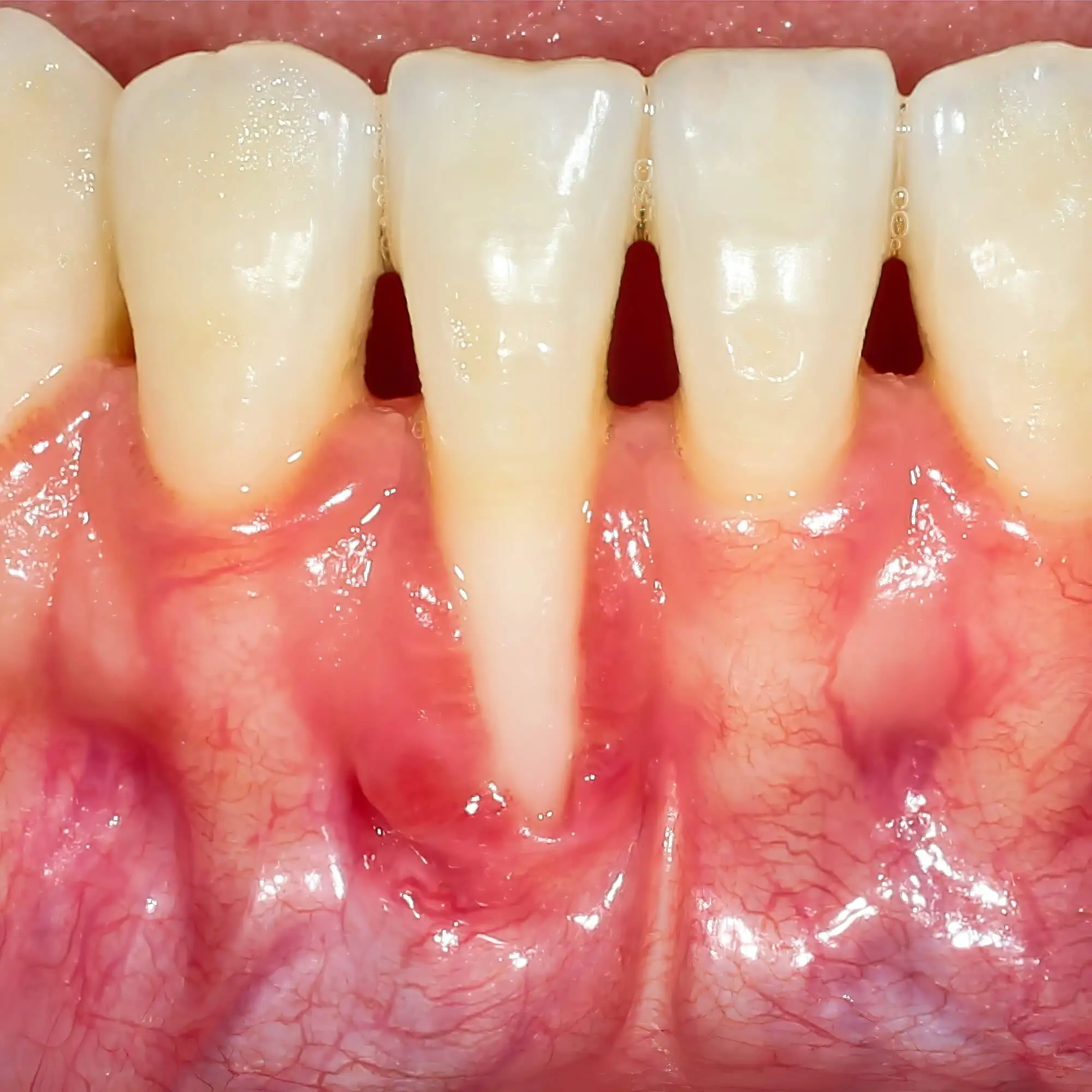 Treat Gum Recession with a Knoxville Dentist in IL