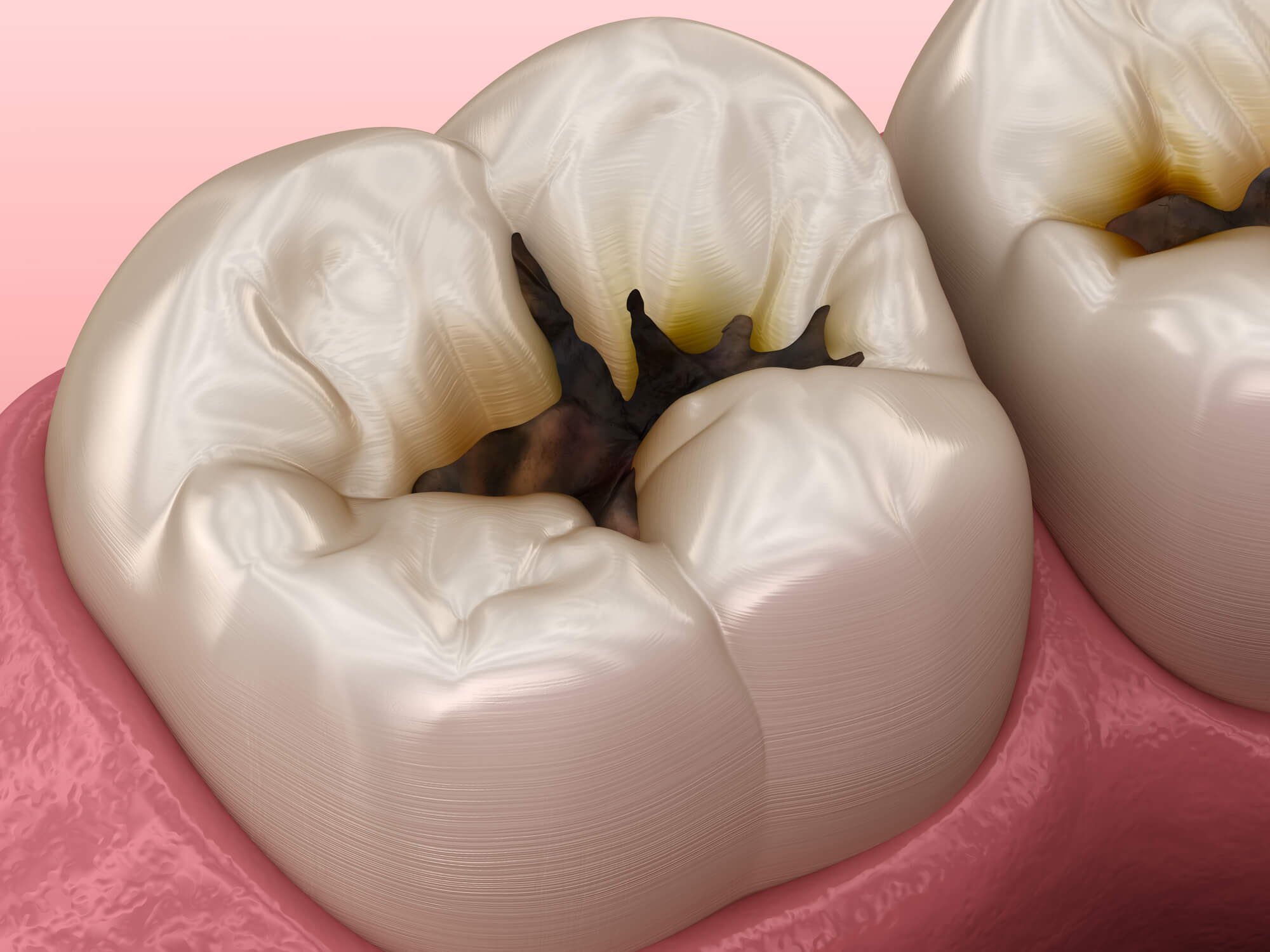 illustration of decaying tooth showed by a dentist in Pekin, IL