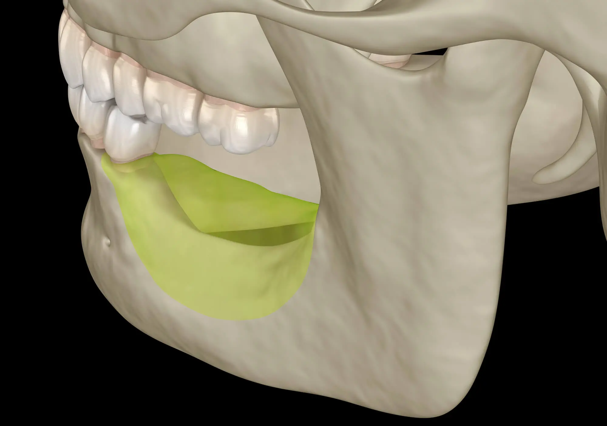 How Missing Teeth Lead to a Full Mouth Rehab in Morton, IL