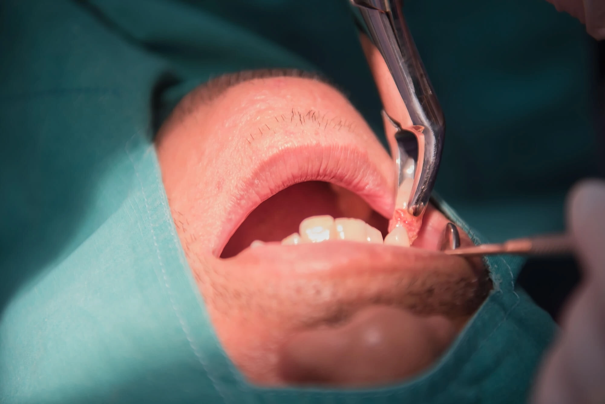 Is Tooth Extraction Really Necessary? A Simple Checklist