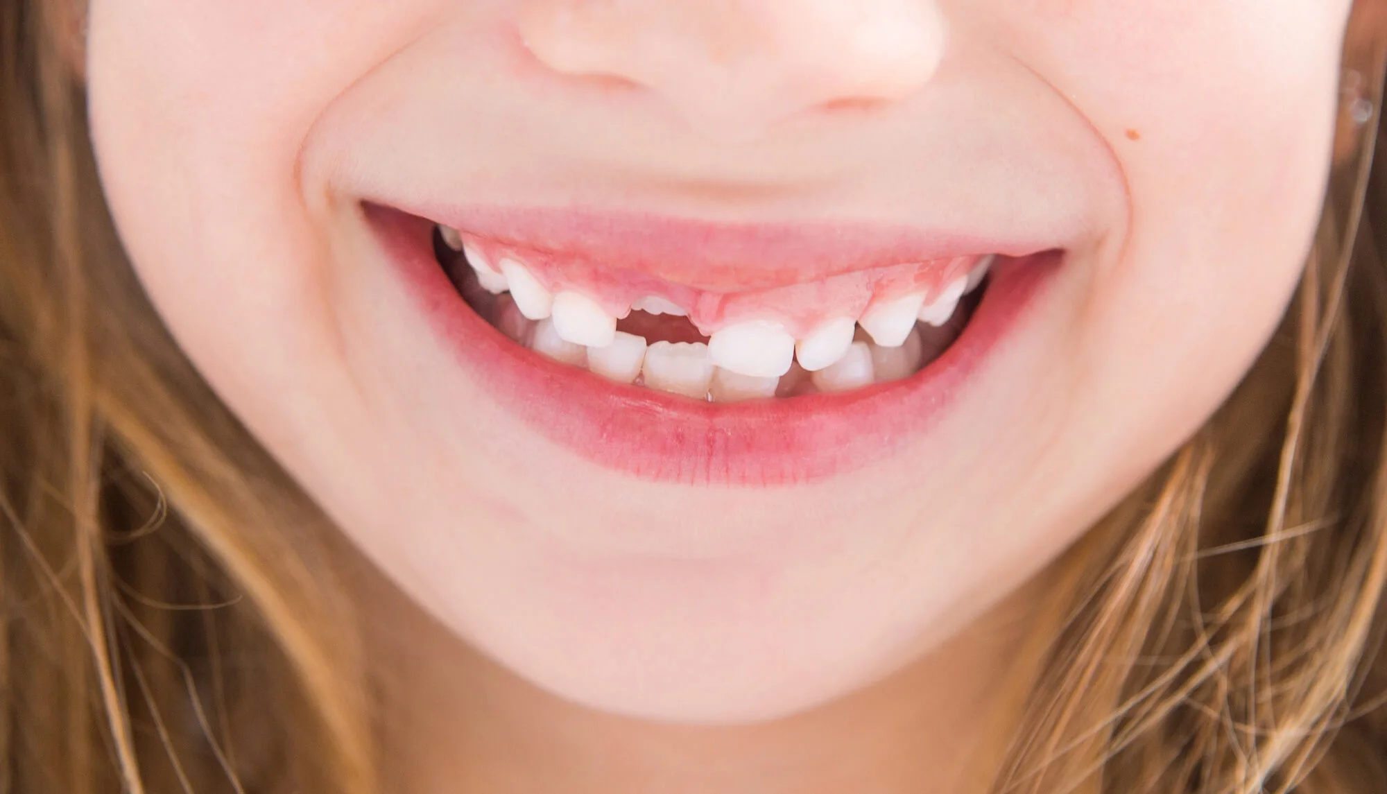 When to Worry About Baby Teeth Not Falling Out