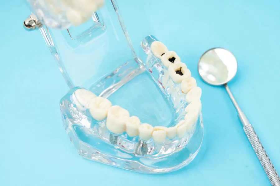 How Do Dentists Choose the Right Dental Filling Material for You?
