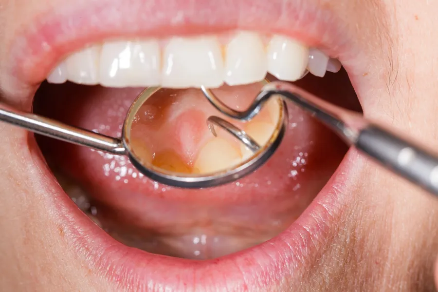Getting an Oral Cancer Screening from a Dentist in Glen Ave, IL
