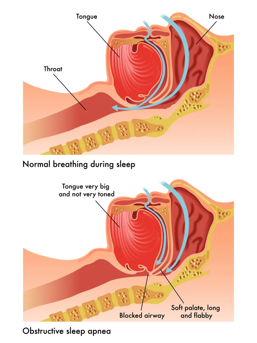 diagram-explaining-normal-vs-obstructive-sleep-apnea