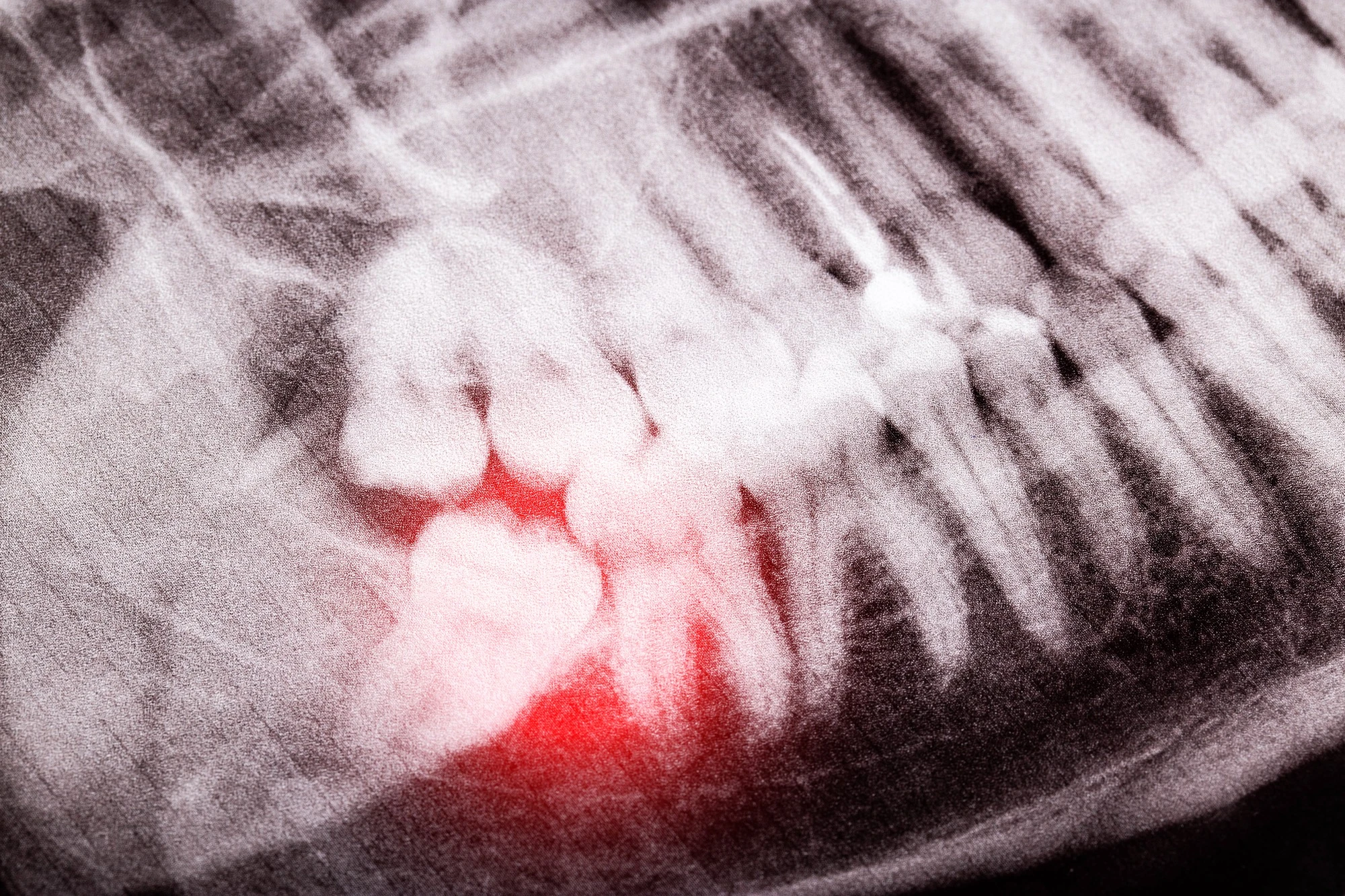 dental-extractions-peoria-il-impacted-wisdom-tooth-xray